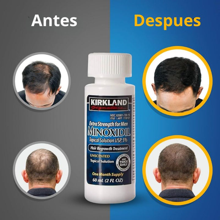 Minoxidil Kirkland 5%